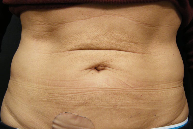 Body by Thermage Before & After Gallery - Patient 187469 - Image 1