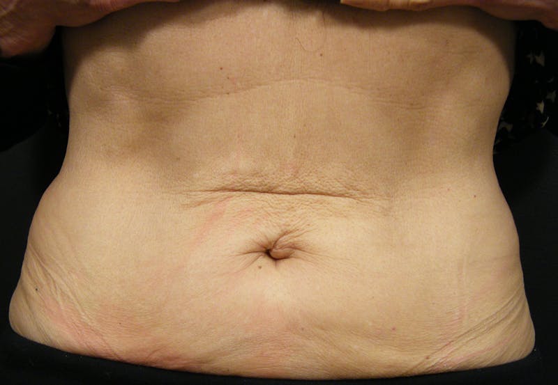 Body by Thermage Before & After Gallery - Patient 187469 - Image 2