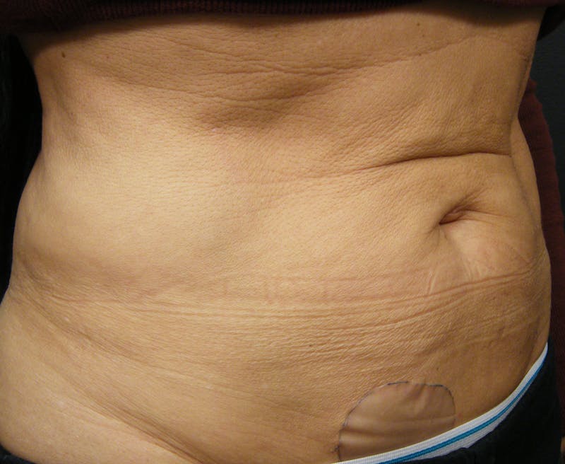 Body by Thermage Before & After Gallery - Patient 187469 - Image 3