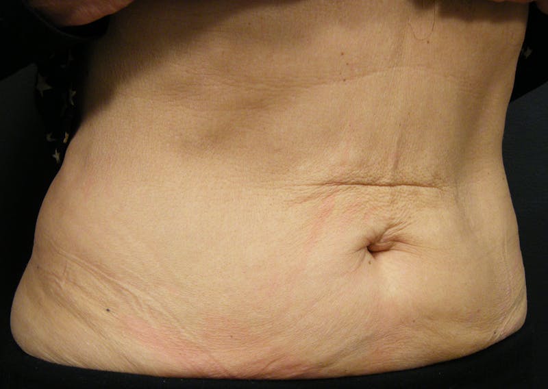 Body by Thermage Before & After Gallery - Patient 187469 - Image 4