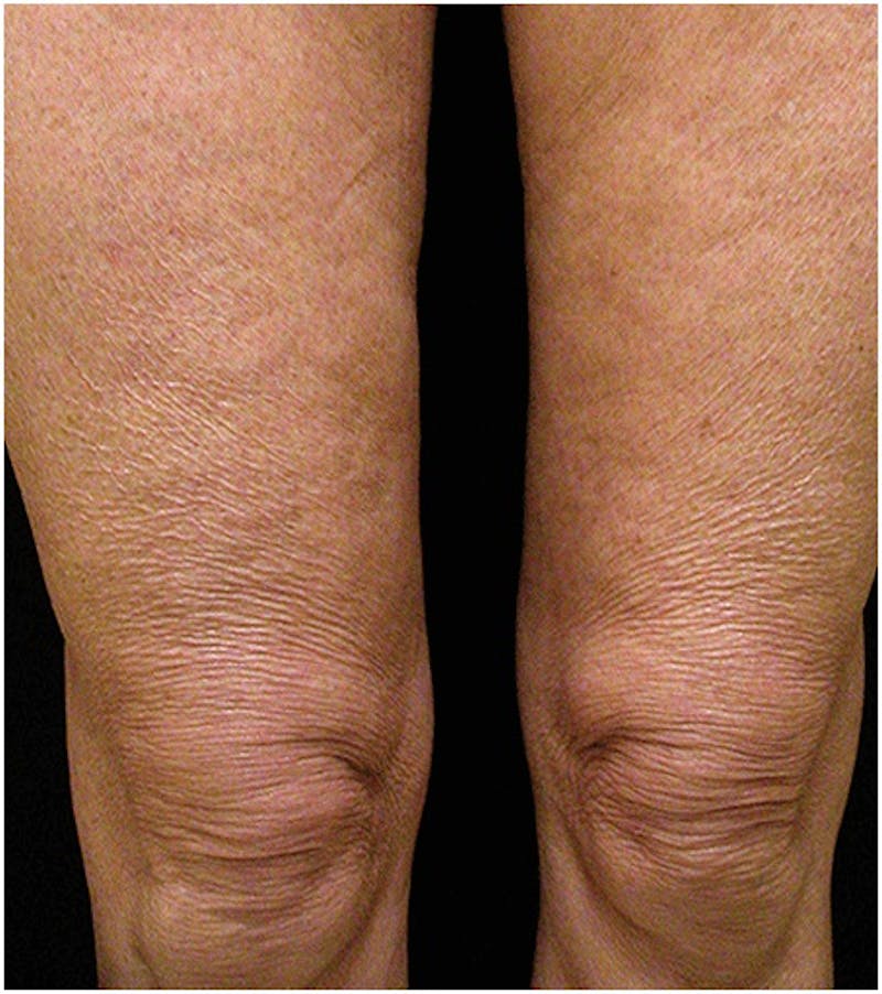 Body by Thermage Before & After Gallery - Patient 354768 - Image 1