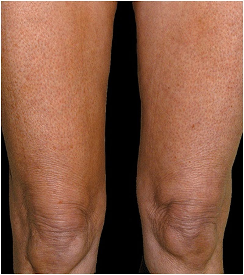 Body by Thermage Before & After Gallery - Patient 354768 - Image 2