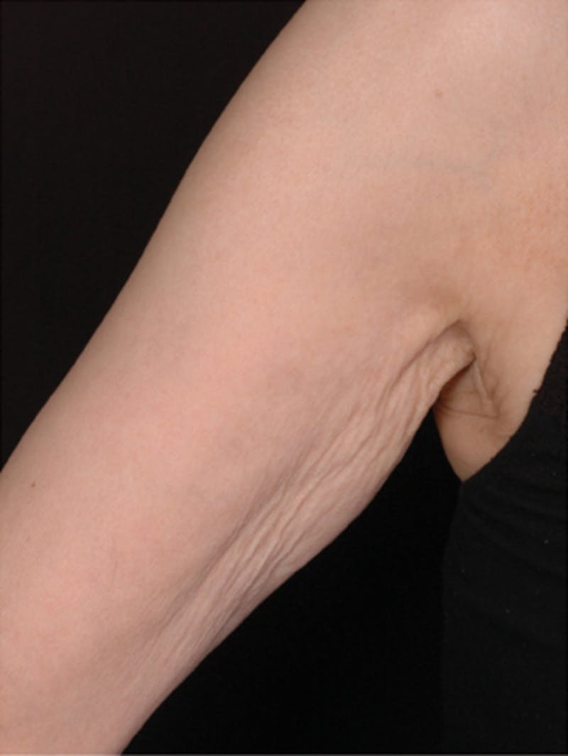 Body by Thermage Before & After Gallery - Patient 169497 - Image 1