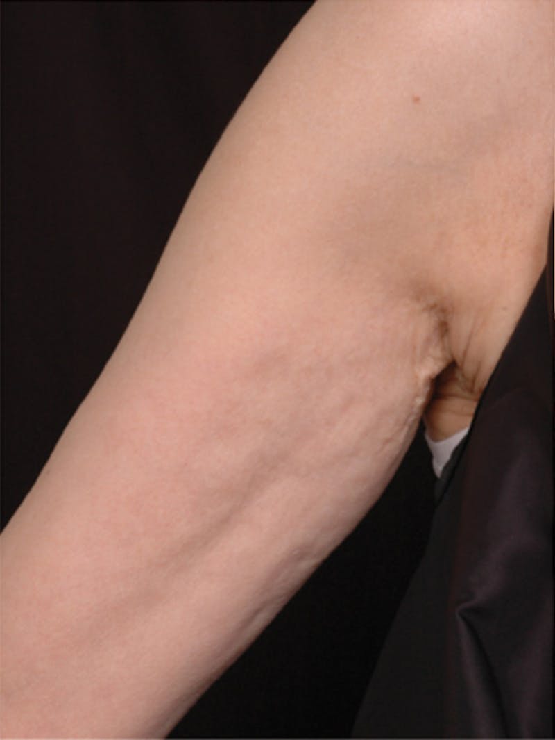 Body by Thermage Before & After Gallery - Patient 169497 - Image 2