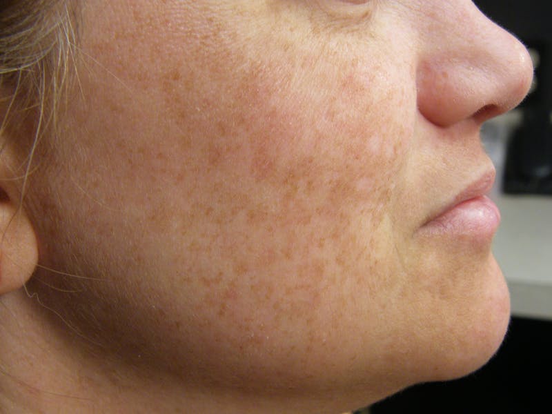 Medical Skin Care Before & After Gallery - Patient 116879 - Image 1