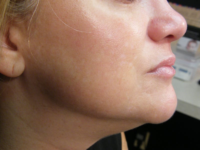 Medical Skin Care Before & After Gallery - Patient 116879 - Image 2