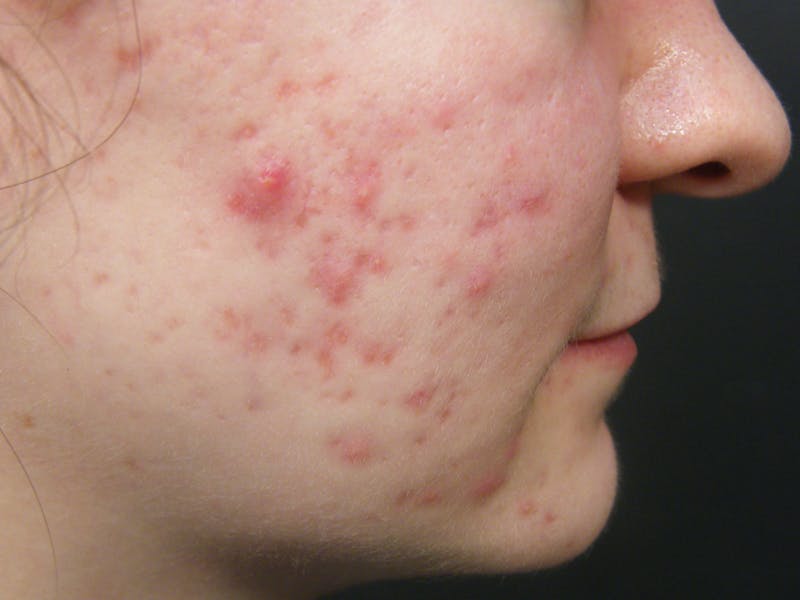 Medical Skin Care Before & After Gallery - Patient 746765 - Image 1