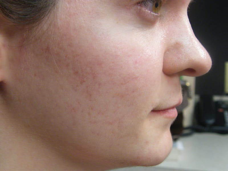 Medical Skin Care Before & After Gallery - Patient 746765 - Image 2