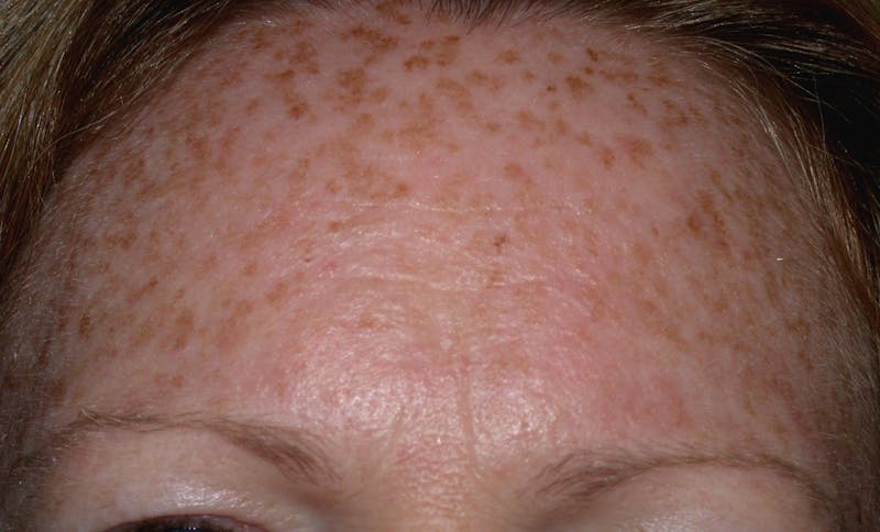 Medical Skin Care Before & After Gallery - Patient 425346 - Image 1