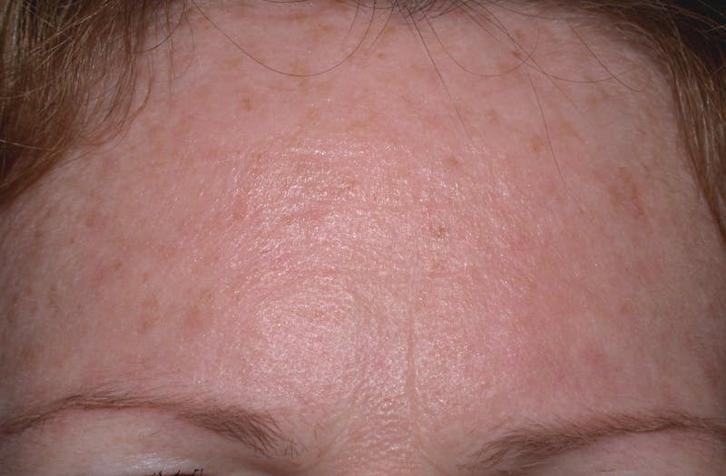 Medical Skin Care Before & After Gallery - Patient 425346 - Image 2