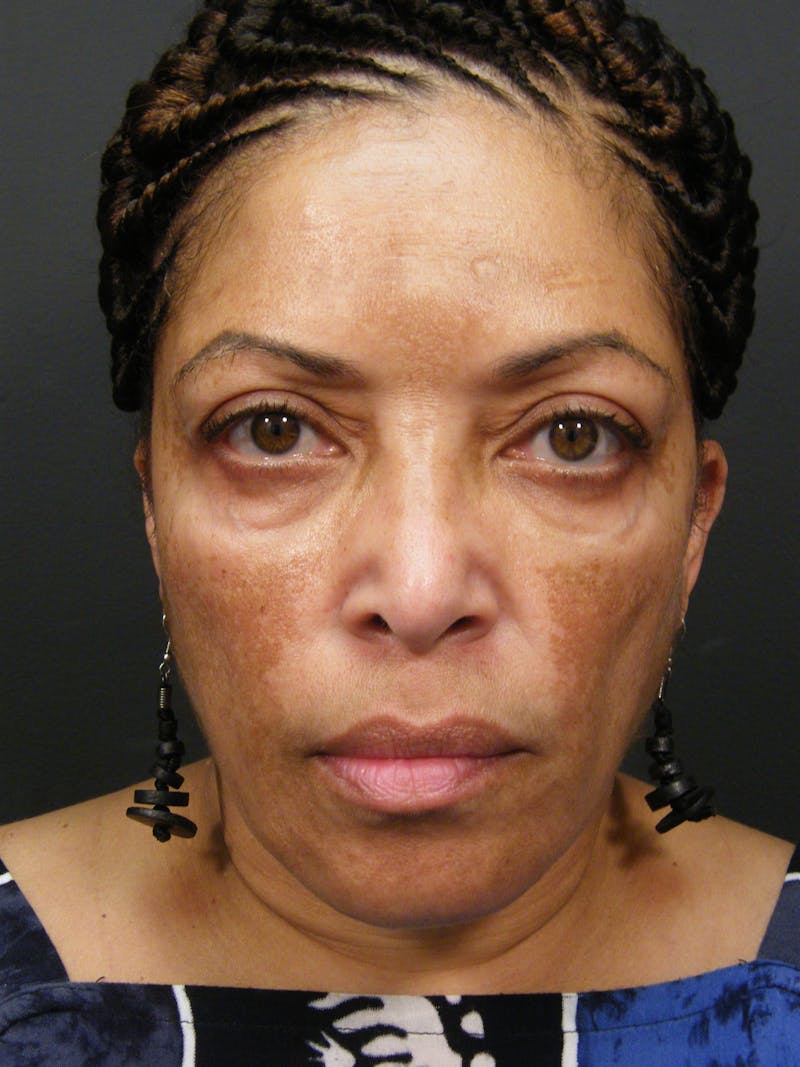 Medical Skin Care Before & After Gallery - Patient 409919 - Image 1