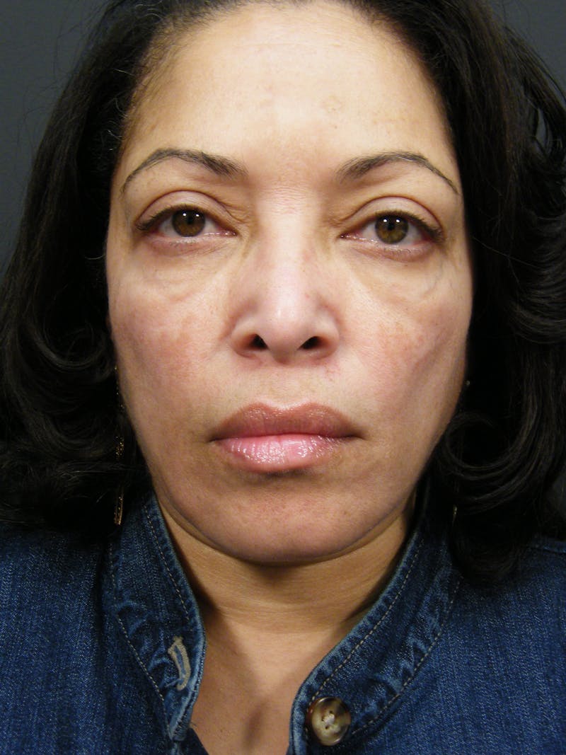 Medical Skin Care Before & After Gallery - Patient 409919 - Image 2