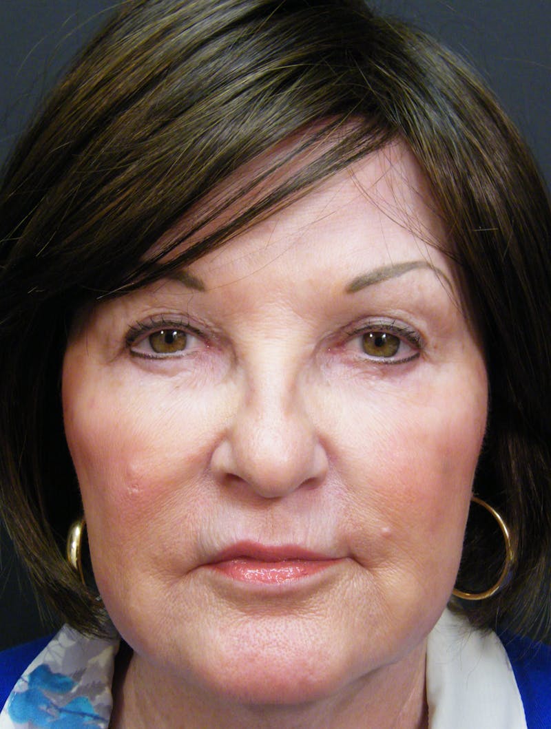 Liquid Facelift & Botunlinum Before & After Gallery - Patient 160315 - Image 4