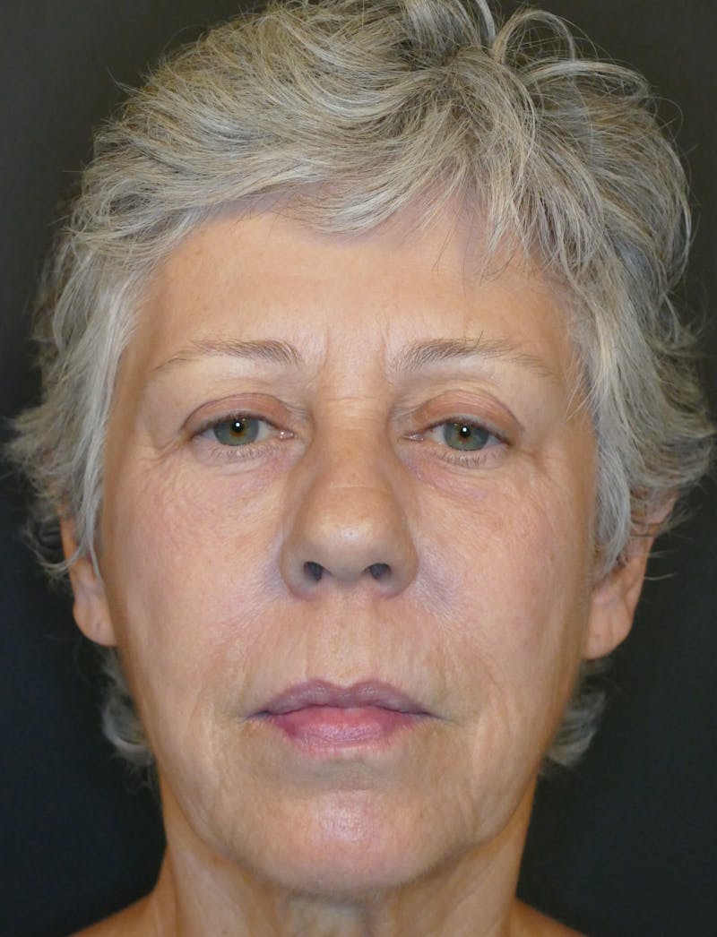 Laser Treatments Before & After Gallery - Patient 189107 - Image 2