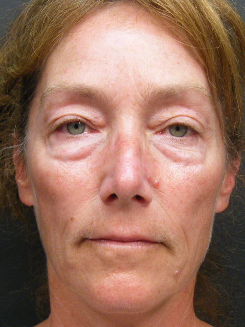 Cosmetic Surgeries Before & After Gallery - Patient 414960 - Image 1
