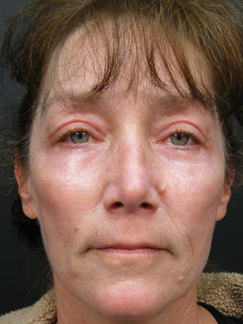Cosmetic Surgeries Before & After Gallery - Patient 414960 - Image 2