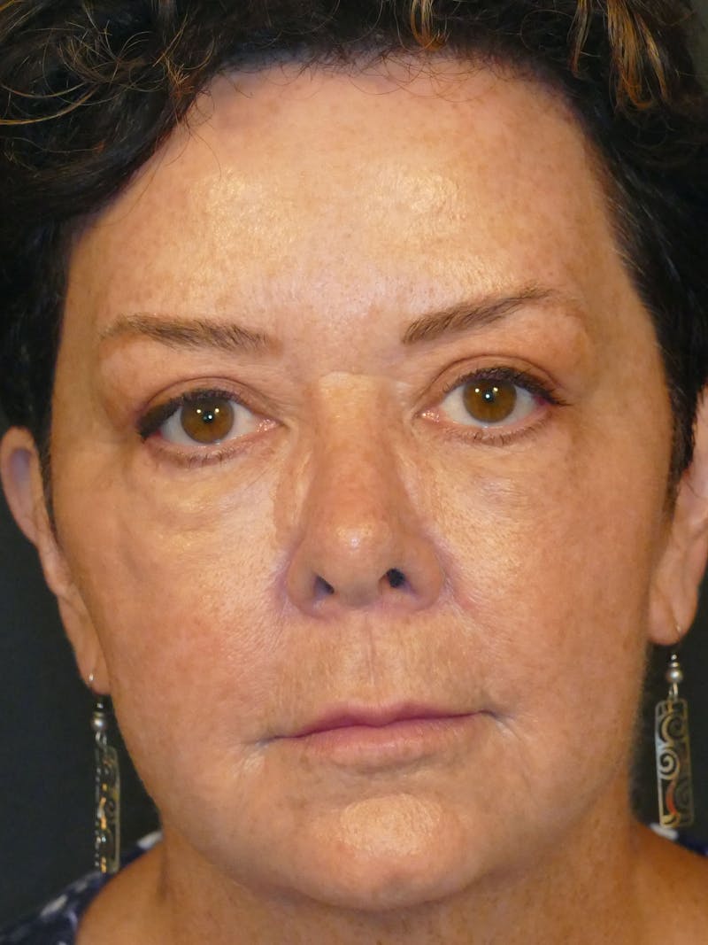 Total Rejuvenation Before & After Gallery - Patient 103589 - Image 2