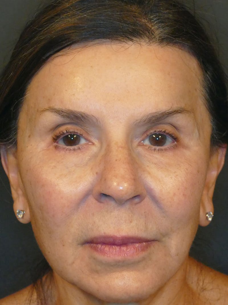Total Rejuvenation Before & After Gallery - Patient 140797 - Image 4