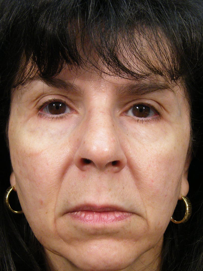 Total Rejuvenation Before & After Gallery - Patient 140797 - Image 1