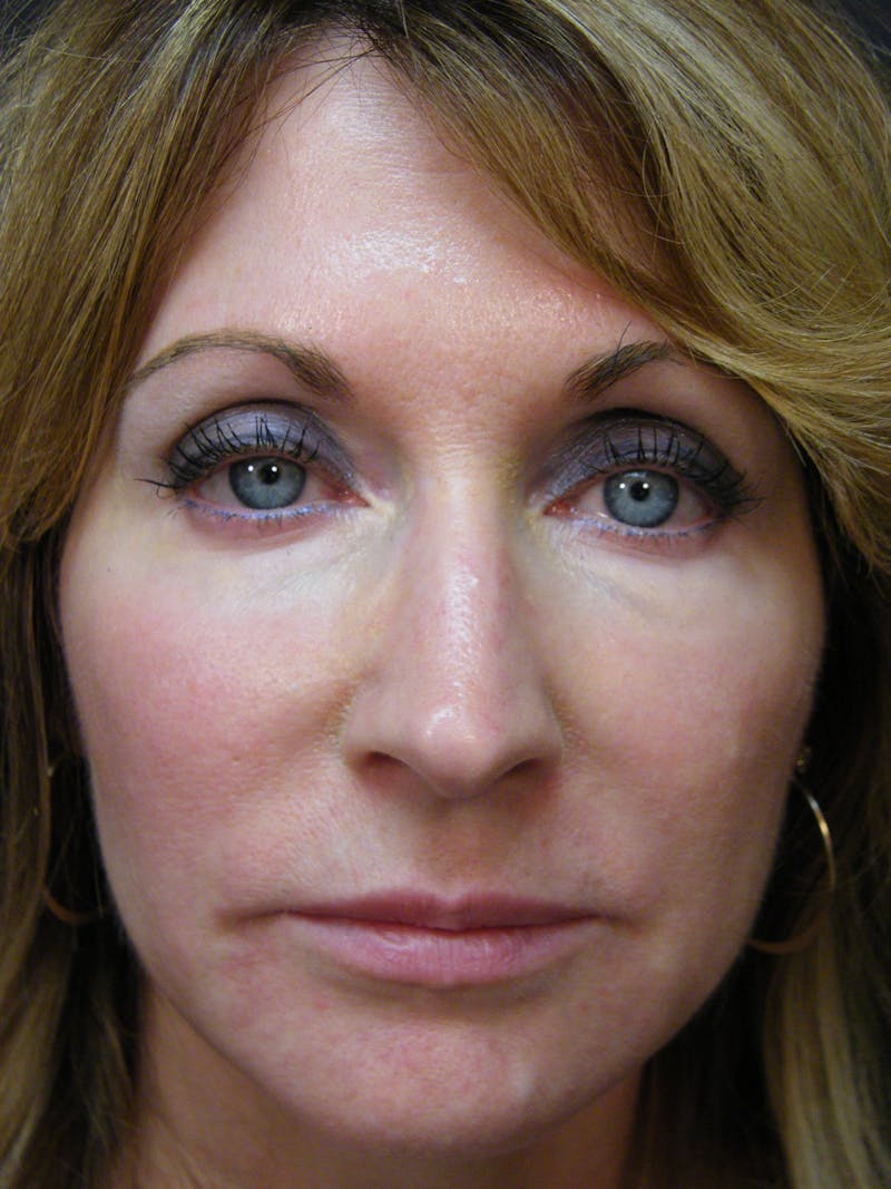 Total Rejuvenation Before & After Gallery - Patient 389114 - Image 2