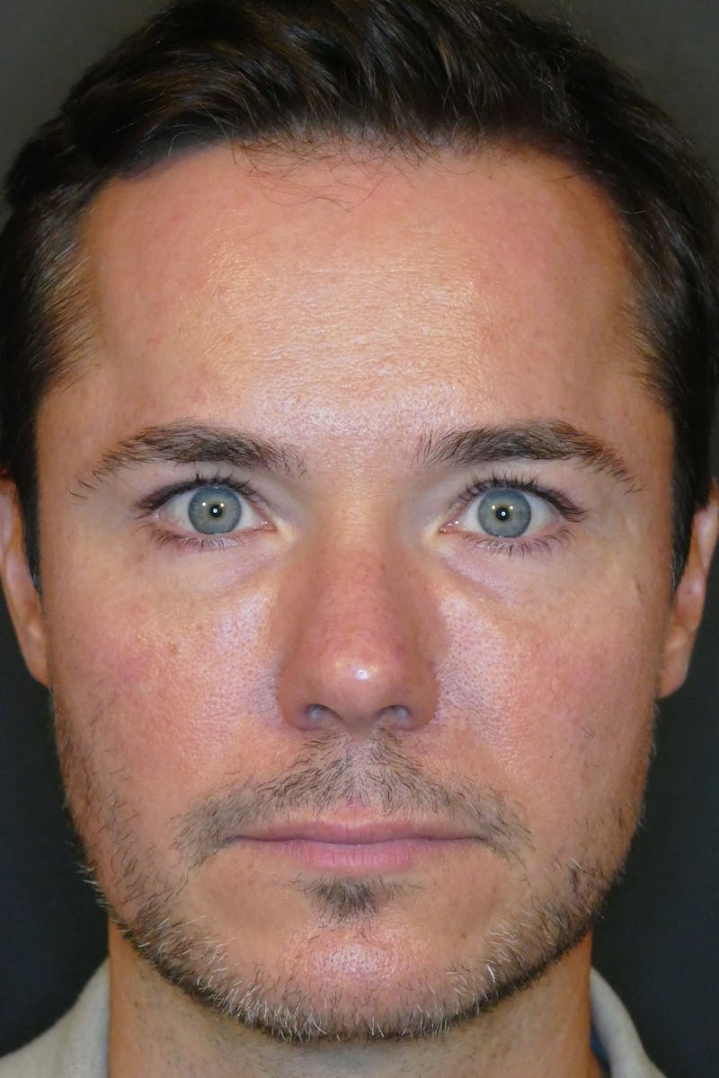 Total Rejuvenation Before & After Gallery - Patient 336235 - Image 1