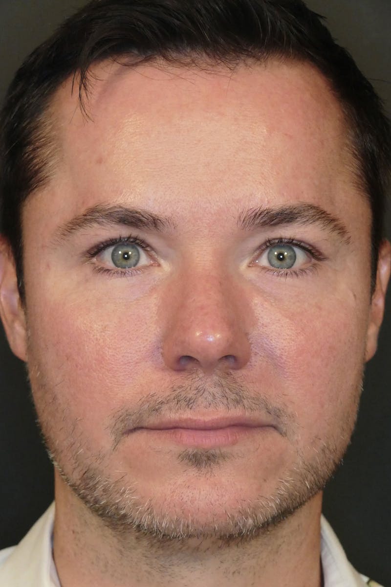 Total Rejuvenation Before & After Gallery - Patient 336235 - Image 2