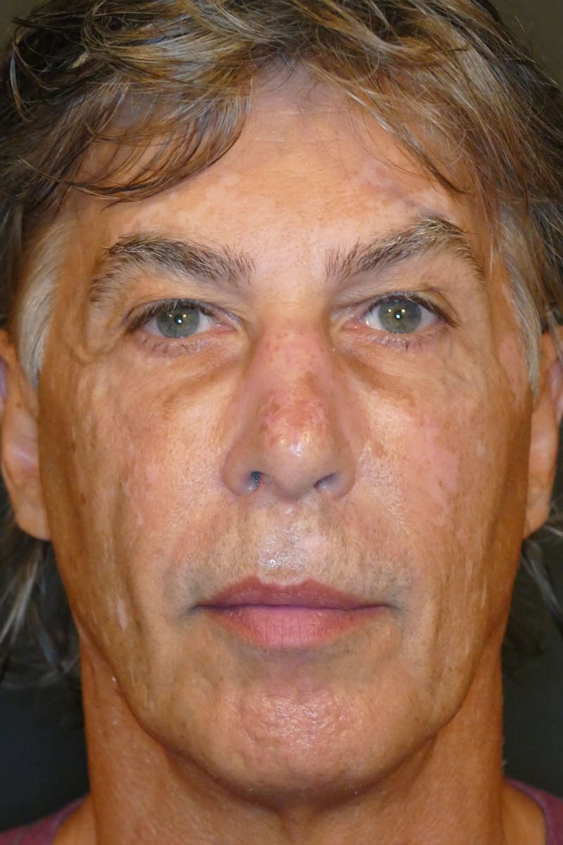 Total Rejuvenation Before & After Gallery - Patient 746349 - Image 1