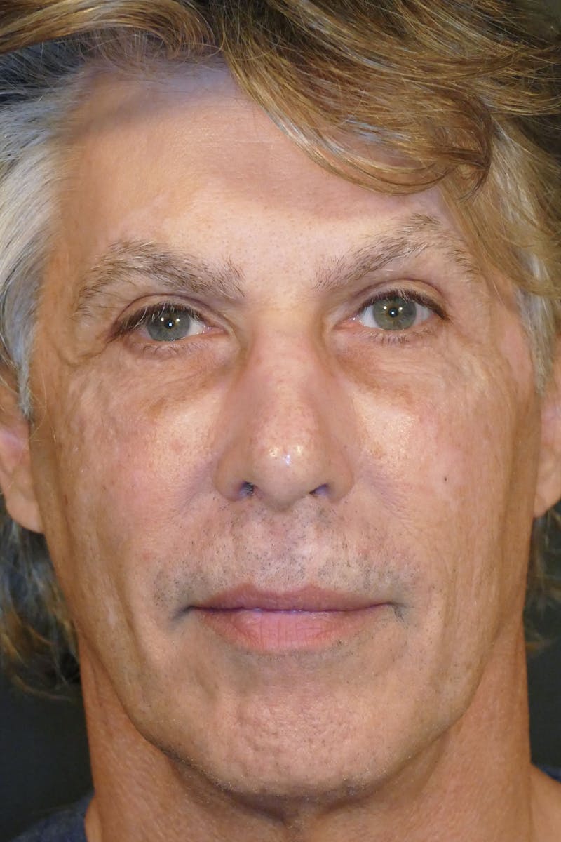 Total Rejuvenation Before & After Gallery - Patient 746349 - Image 2