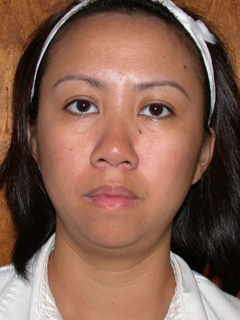 Thermage Before & After Gallery - Patient 228823 - Image 1