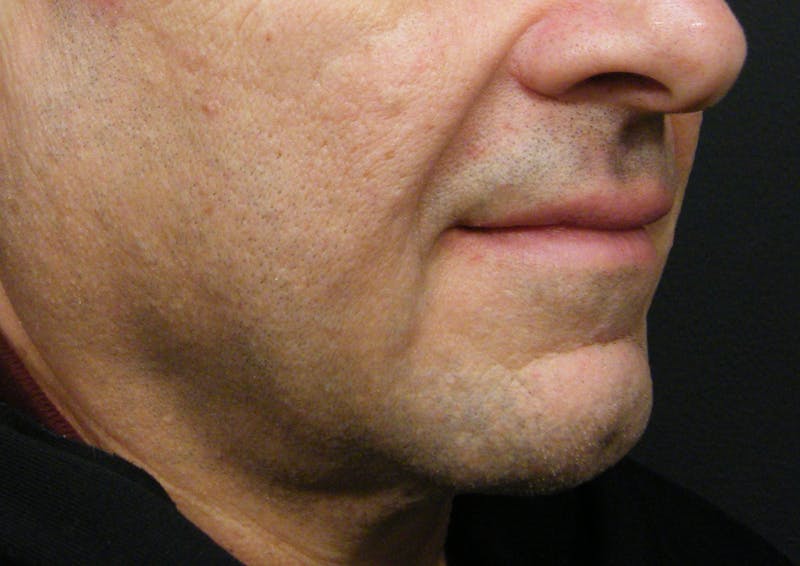 Thermage Before & After Gallery - Patient 324016 - Image 1