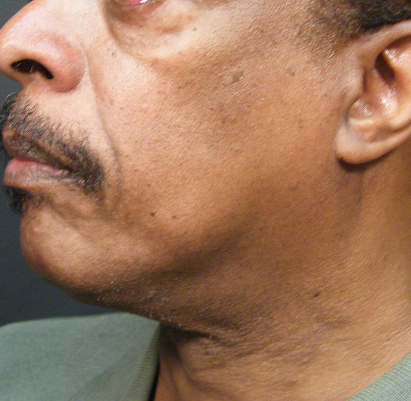 Thermage Before & After Gallery - Patient 339415 - Image 2
