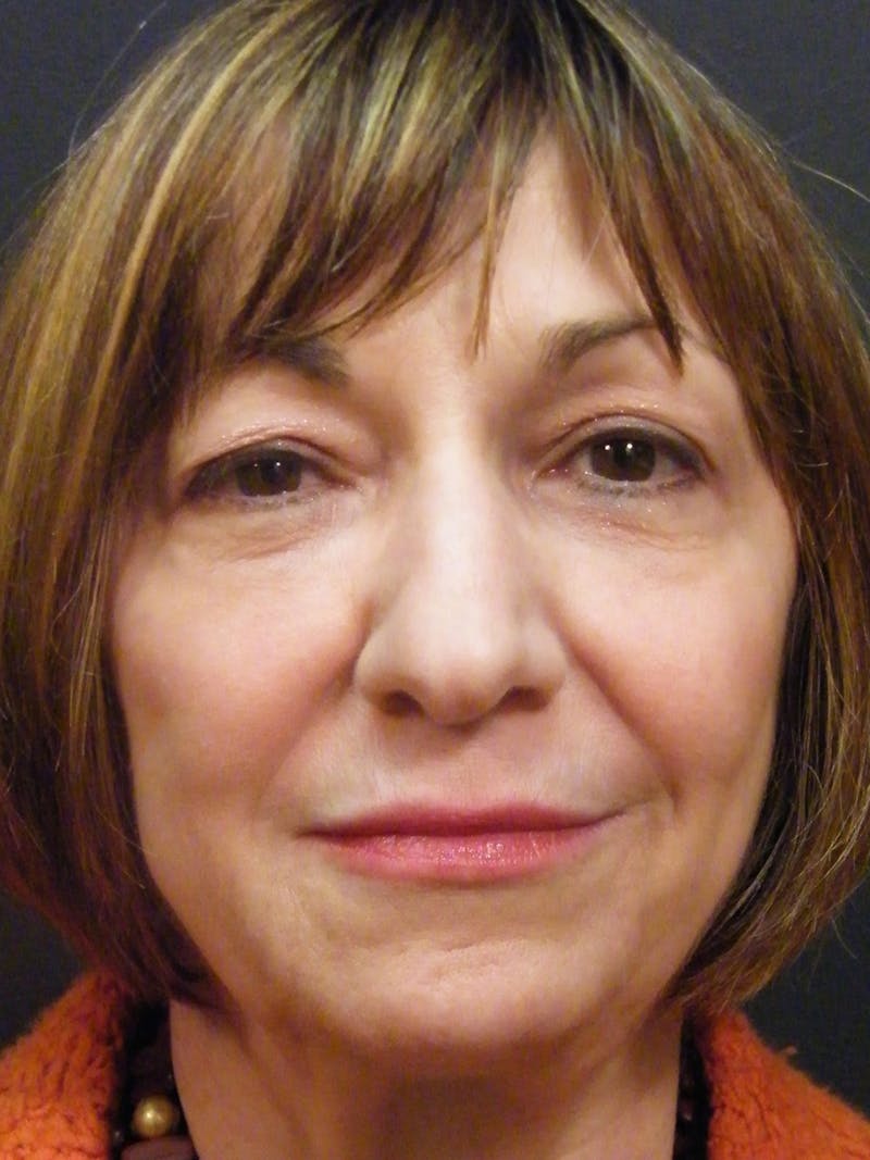 Liquid Facelift & Botunlinum Before & After Gallery - Patient 998712 - Image 2