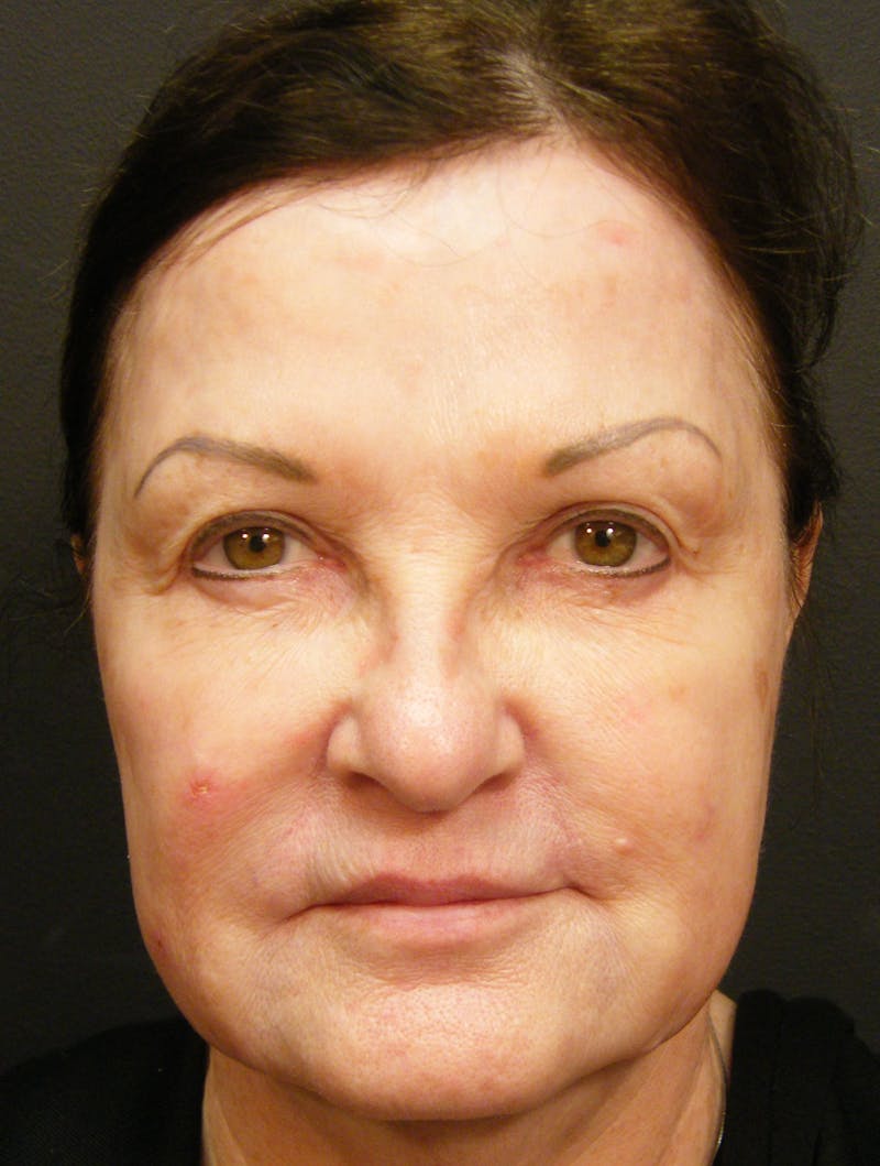 Liquid Facelift & Botunlinum Before & After Gallery - Patient 160315 - Image 3