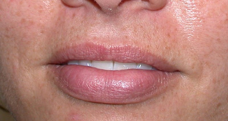 Liquid Facelift & Botunlinum Before & After Gallery - Patient 294616 - Image 1
