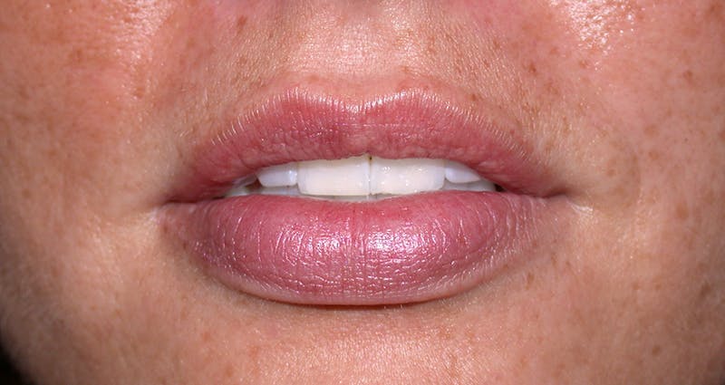 Liquid Facelift & Botunlinum Before & After Gallery - Patient 294616 - Image 2