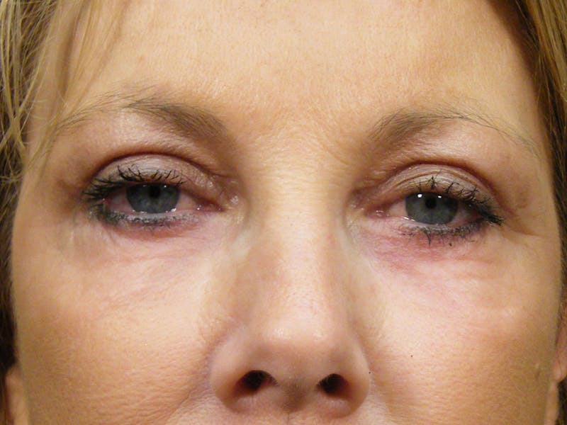 Cosmetic Surgeries Before & After Gallery - Patient 172846 - Image 2