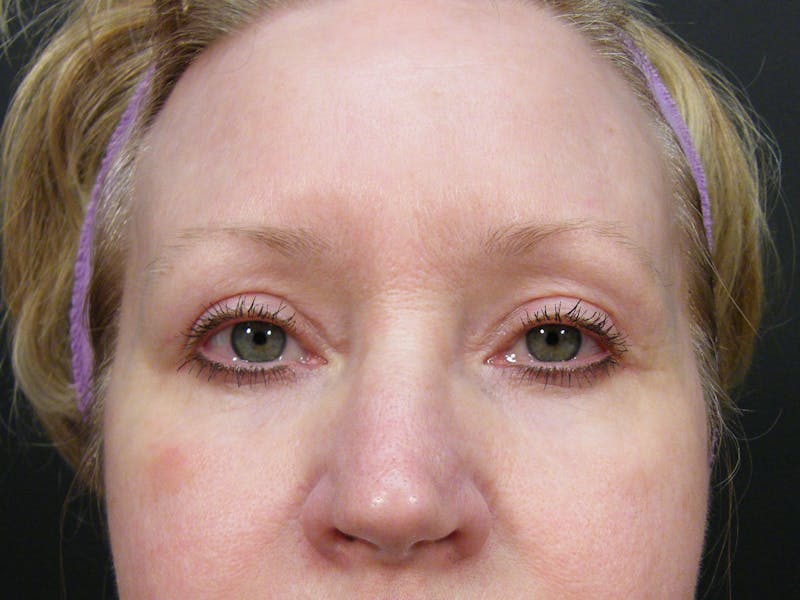 Cosmetic Surgeries Before & After Gallery - Patient 727574 - Image 2