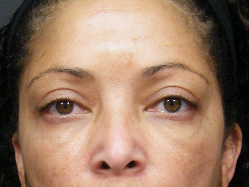 Cosmetic Surgeries Before & After Gallery - Patient 106609 - Image 2