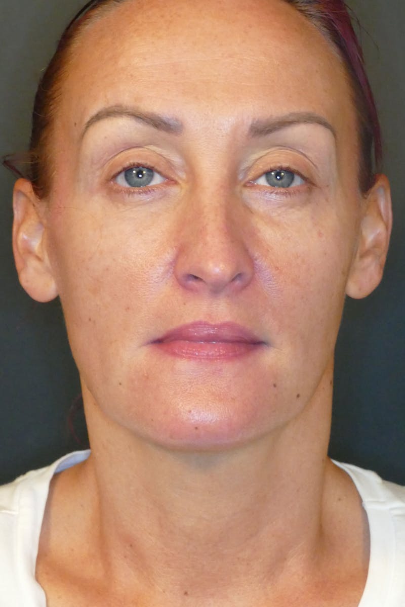 Laser Treatments Before & After Gallery - Patient 423258 - Image 2