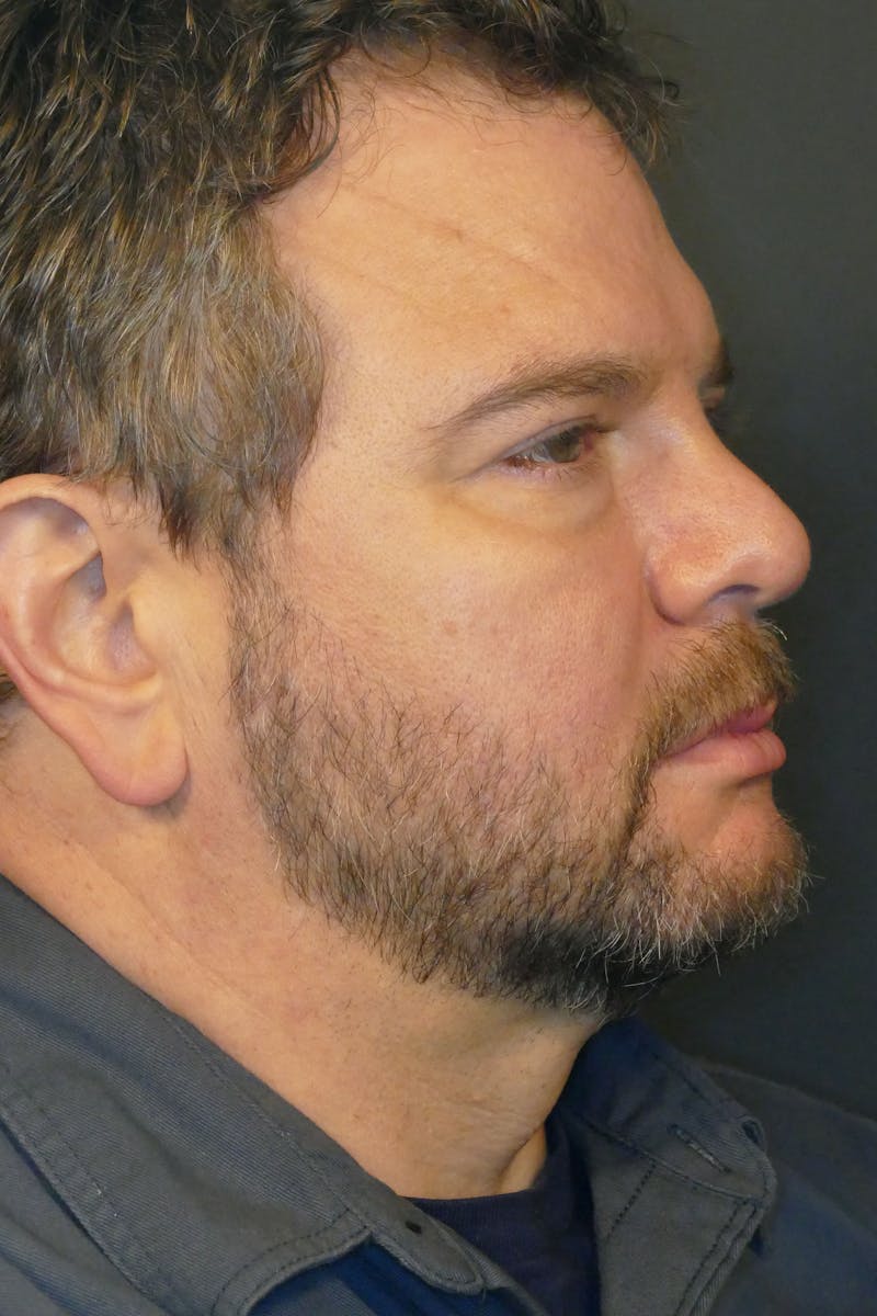 Photorejuvenation Before & After Gallery - Patient 414818 - Image 2