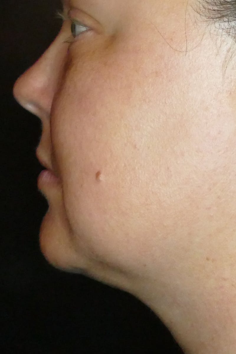 Kybella Before & After Gallery - Patient 687384 - Image 1