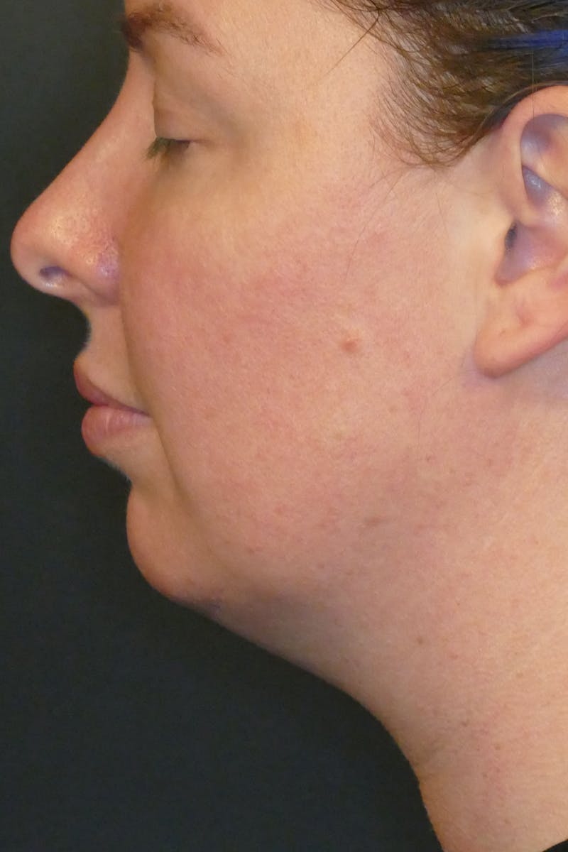 Kybella Before & After Gallery - Patient 112066 - Image 2