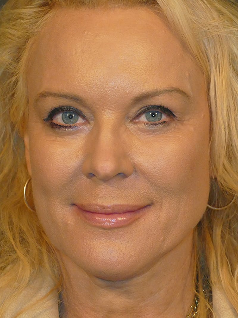 Cosmetic Surgeries Before & After Gallery - Patient 104455 - Image 2