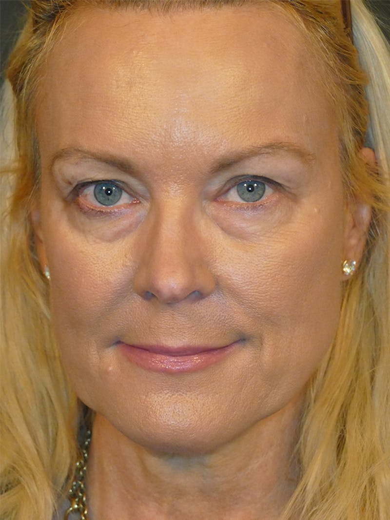 Cosmetic Surgeries Before & After Gallery - Patient 104455 - Image 1