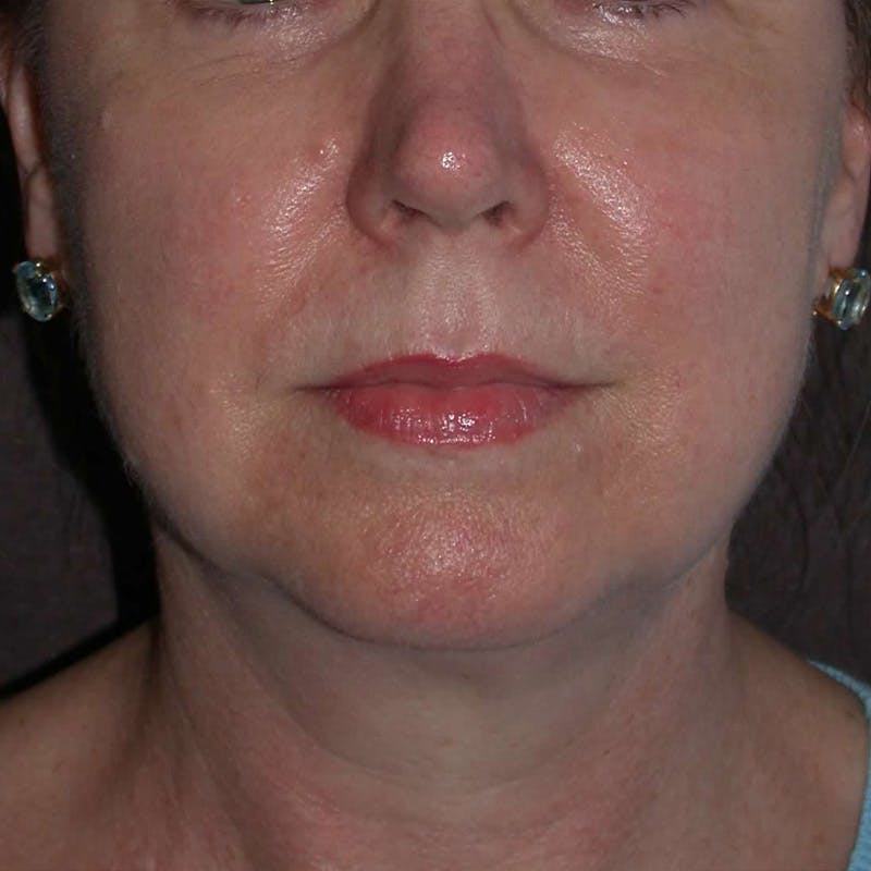 Thermage Before & After Gallery - Patient 223617 - Image 4
