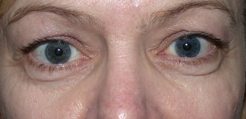 Cosmetic Surgeries Before & After Gallery - Patient 167778 - Image 1