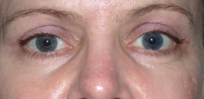 Cosmetic Surgeries Before & After Gallery - Patient 167778 - Image 2