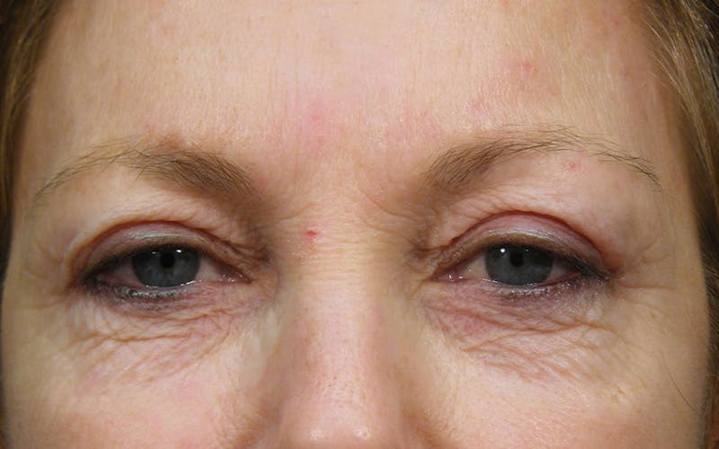 Cosmetic Surgeries Before & After Gallery - Patient 172846 - Image 1