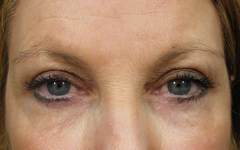 Cosmetic Surgeries Before & After Gallery - Patient 172846 - Image 2