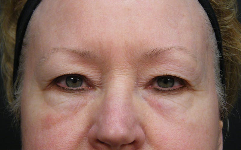 Cosmetic Surgeries Before & After Gallery - Patient 727574 - Image 1
